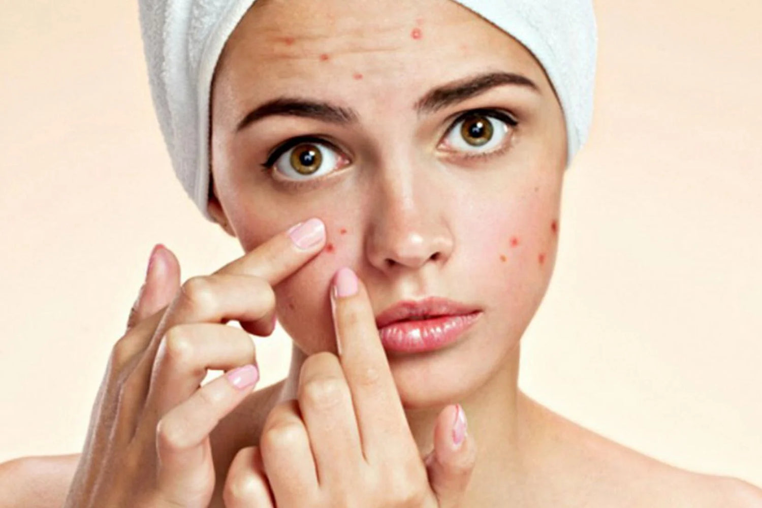 Dear Acne, Let’s Break Up