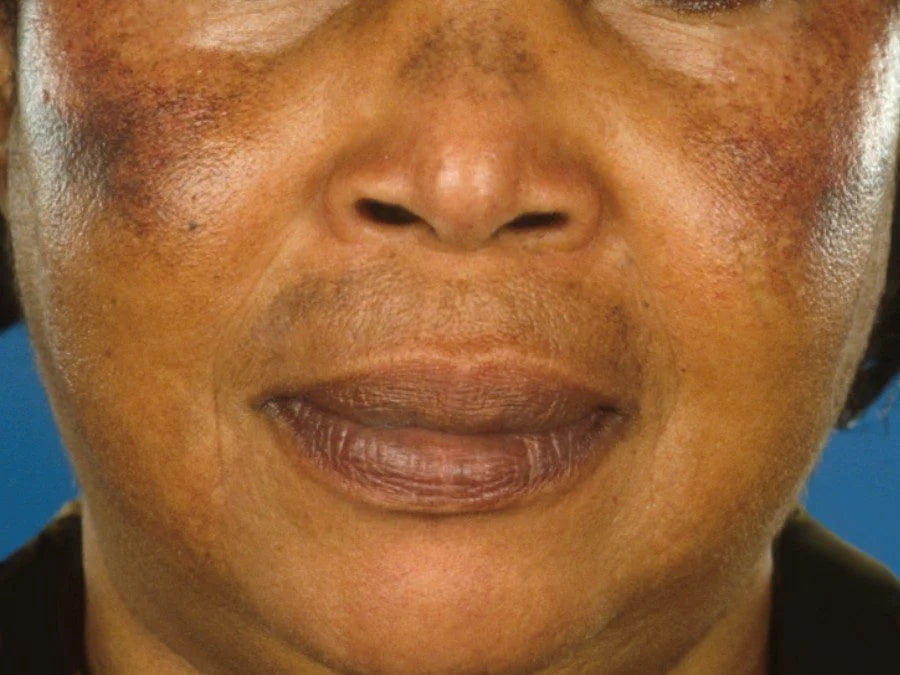 Skin Bleaching – Exogenous Ochronosis